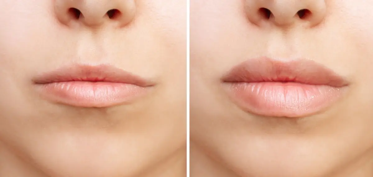 Labios: antes y después del relleno.