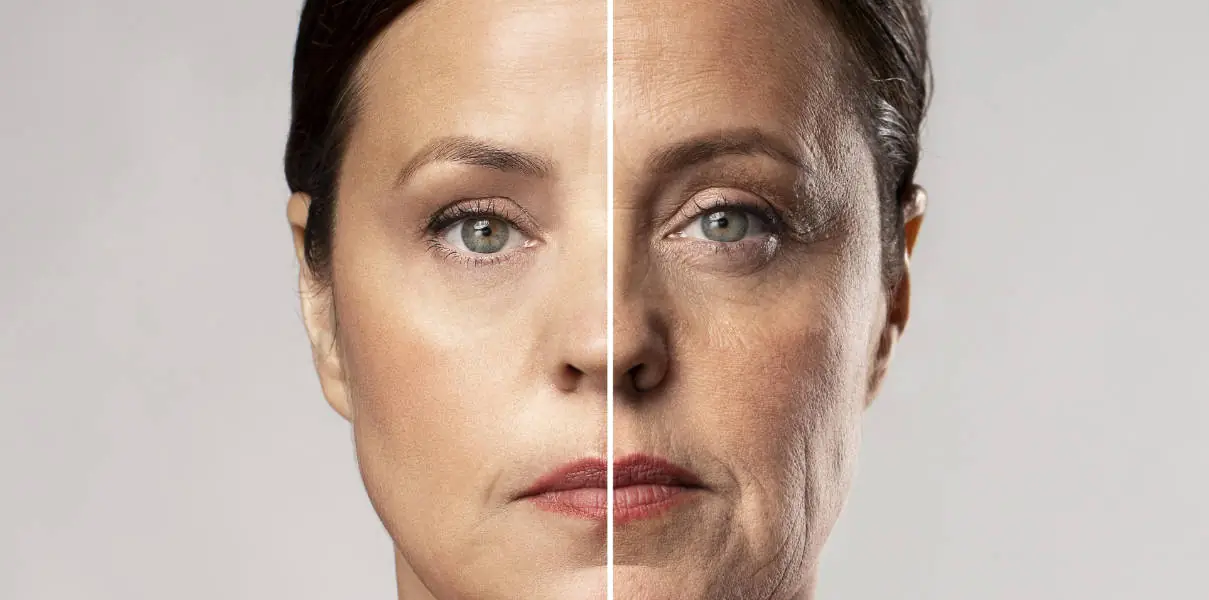 Woman defore and after biorevitalization