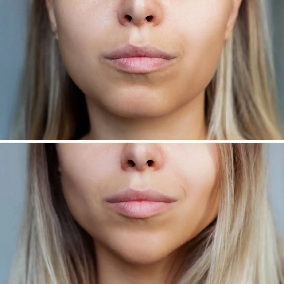 Juvederm Ultra Smile - before and after lip filler