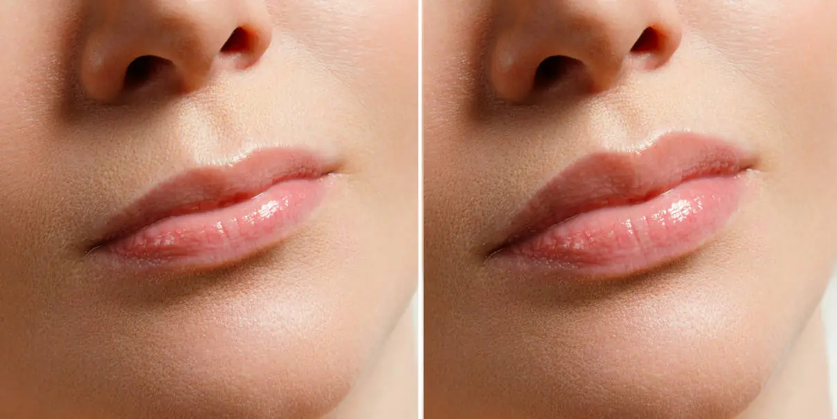 Rejeunesse Deep - antes y después del relleno de labios