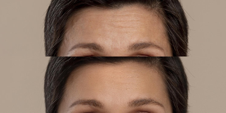 Forehead wrinkles - before and after
