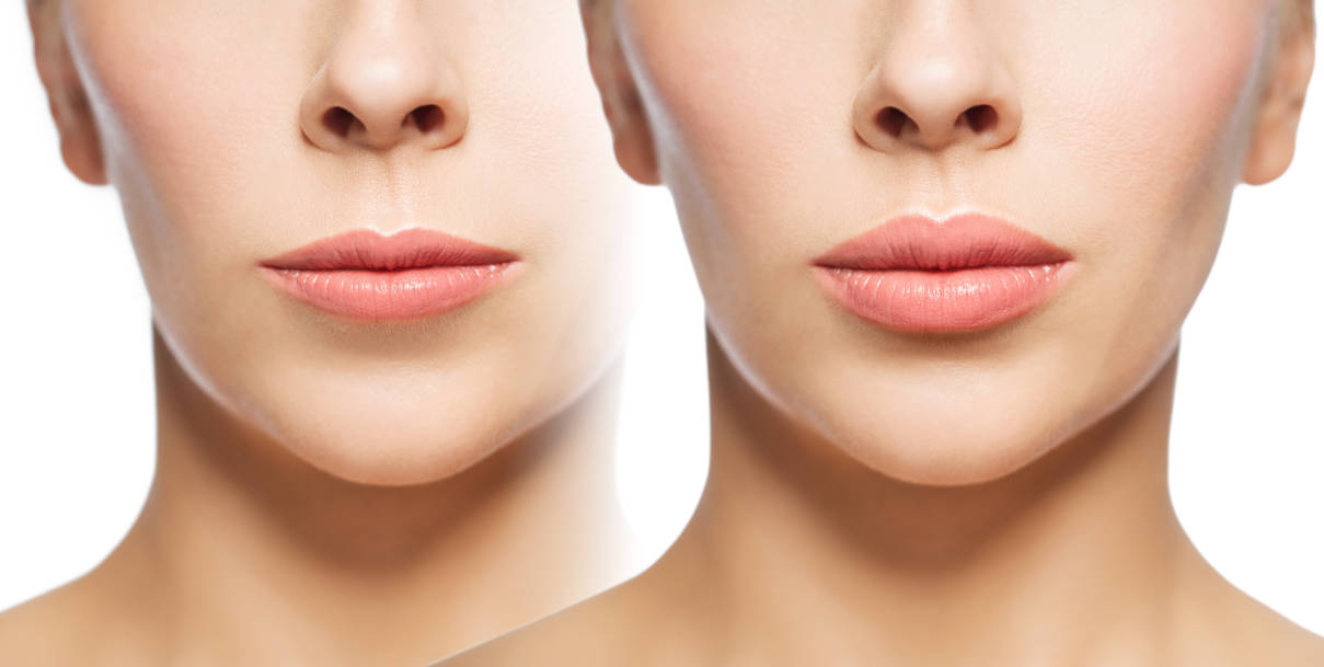 Comparación de rellenos de labios: antes y después