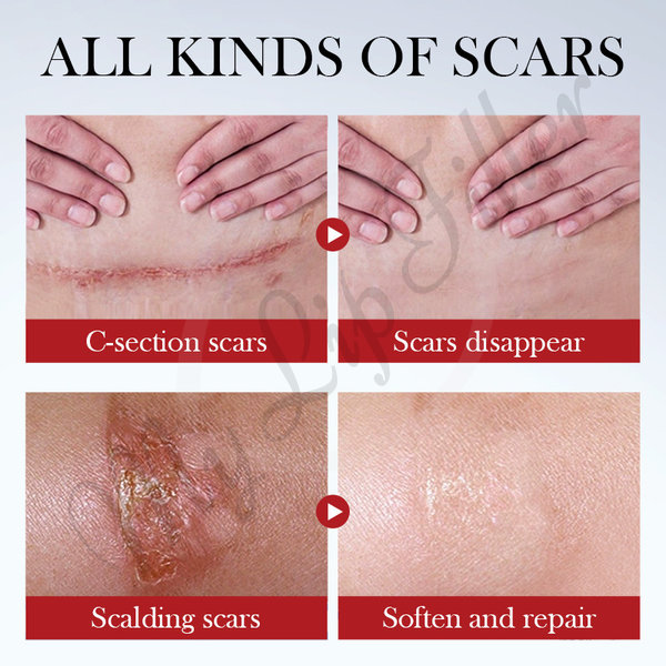Sadoer Scar Repair Serum by mylipfiller.com - photo 2 Sadoer Scar Repair Serum - My Lip Filler - photo 2